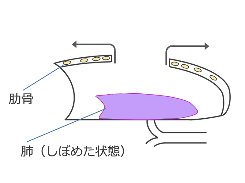 開胸手術の説明イラスト