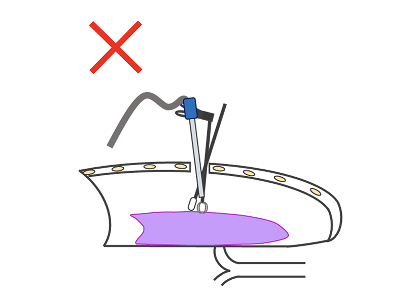 胸腔鏡手術(単孔式)の良くない例の説明イラスト