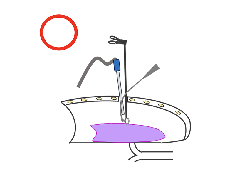 胸腔鏡手術(単孔式)の良い例の説明イラスト