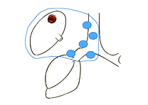 一般的な肺がん手術の模式図