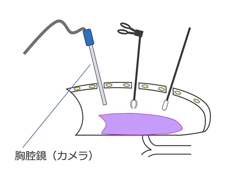 胸腔鏡手術(多孔式)の説明イラスト